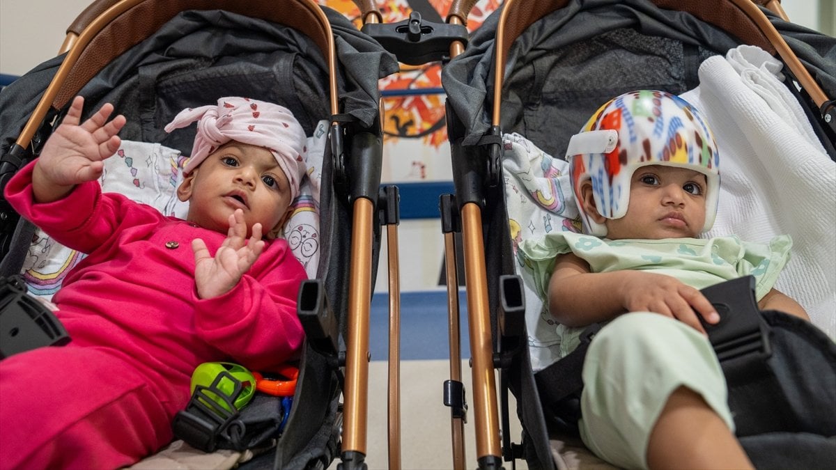 Türkiye'ye getirilen Pakistanlı yapışık ikizler 14 saatlik operasyonla ayrıldı