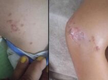 9 yaşındaki çocuk denizden çıktıktan sonra fenalaştı! Vücudunda çıkan lekelerle ilgili korkunç şüphe