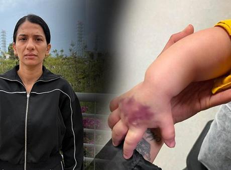 Doktor ‘bir şeyi yok’ dedi! Her şey morarmayla başladı: Çocuğumun kolu dirseğe kadar açıldı